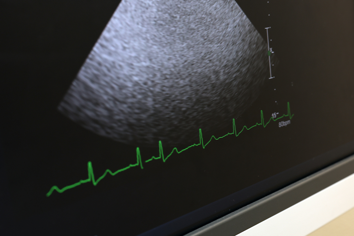 Diagbnostic Ultrasound closeup scan
